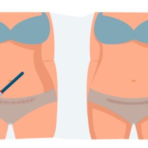 بهترین دکتر لیپوماتیک شکم در مشهد