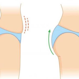 بهترین دکتر لیفت باسن در اصفهان