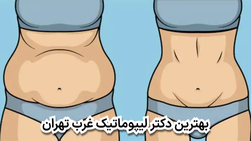 بهترین دکتر لیپوماتیک شرق تهران