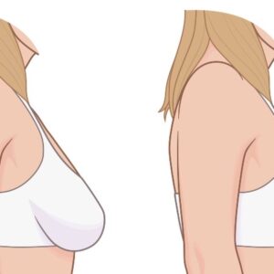 بهترین دکتر لیفت سینه در کرج