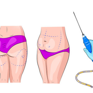 بهترین دکتر لیپوماتیک در قائمشهر