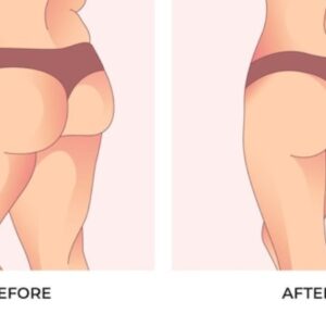 بهترین دکتر لیفت باسن در ارومیه