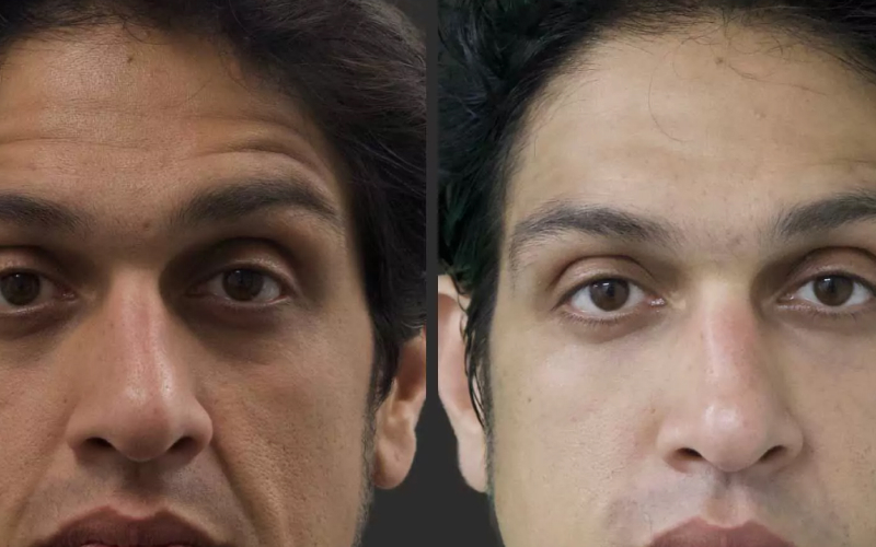 عکس تزریق فیلر زیر چشم